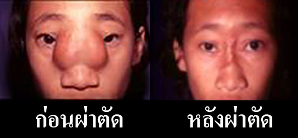 โรคงวงช้าง ก่อนและหลังผ่าตัด