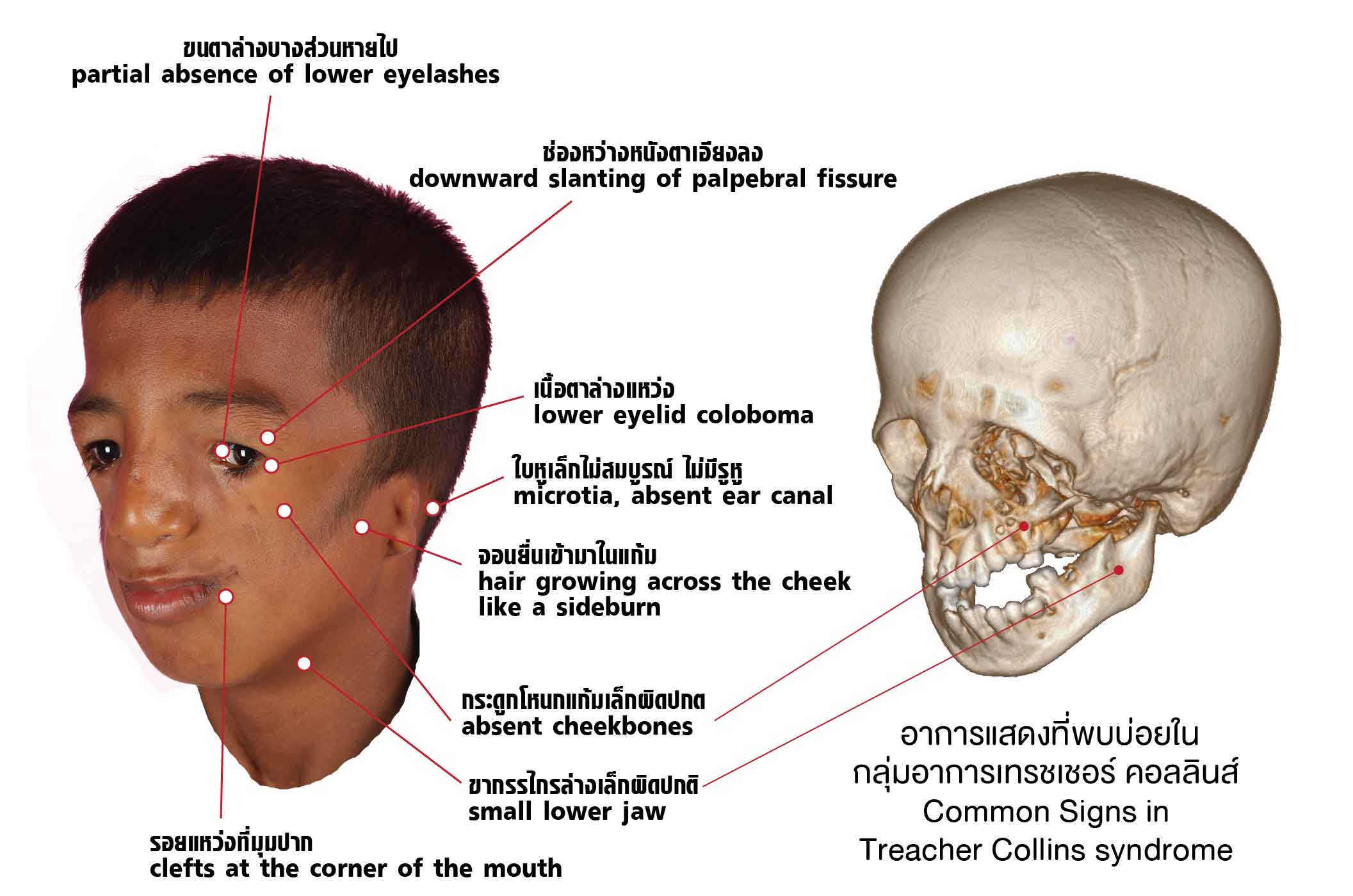 อาการแสดงที่พบบ่อยในกลุ่มอาการเทรชเชอร์ คอลลินส์ (Treacher Collins syndrome) ภาพโดยนพ.นนท์ โรจน์วชิรนนท์